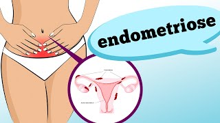 ENDOMETRIOSE COMO IDENTIFICAR [upl. by Brice97]