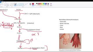 Iron Fe Metabolism  Hereditary Hemochromatosis [upl. by Artimid323]