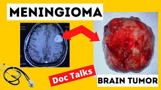 What Is A Meningioma Tumor [upl. by Scrope]