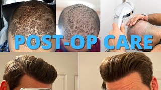 Hair Transplant PostOp Care 101 How To Wash Your Hair After Surgery [upl. by Durrell464]