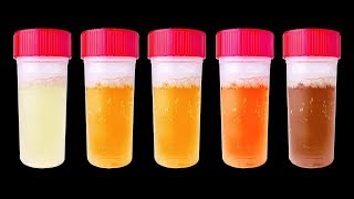 7 Choses Que Ton Urine Peut Révéler Sur ta Santé [upl. by Yelah]