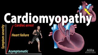 Cardiomyopathy animation [upl. by Gonta]