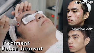 KUPAS TUNTAS TREATMENT BEKAS JERAWAT di Klinik Dermaster TANAM BENANG [upl. by Silvanus]