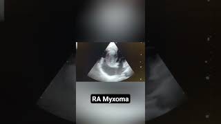 RA Myxoma in echo [upl. by Analaj]