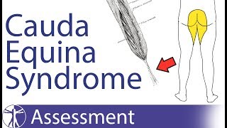 Cauda Equina Syndrome  Signs amp Symptoms [upl. by Sweet]