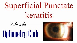 Superficial Punctate Keratitis Introduction Diagnosis and Treatment [upl. by Okechuku]