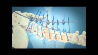 Scoliosis Surgical Correction with Instrumentation [upl. by Howarth459]